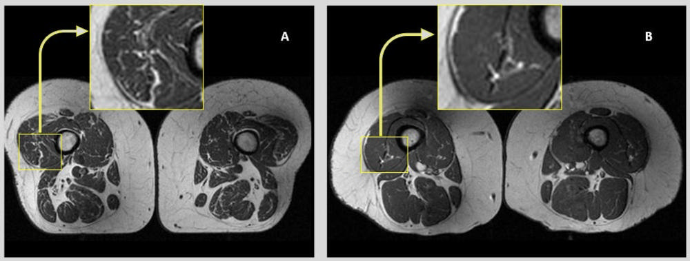 大腿 MRI 对比图